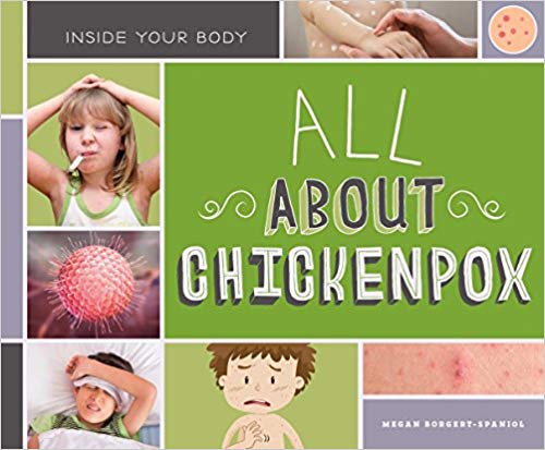 All about Chickenpox